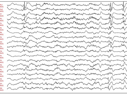 Hashimoto's encephalopathy steroid treatment