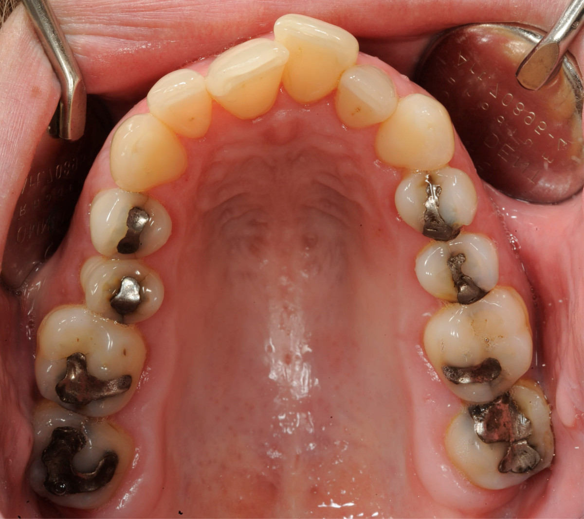 crowded teeth marfan