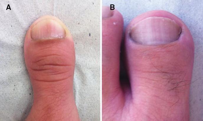 Rubinstein-Taybi syndrome-showing distinctive clinical features