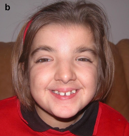 Dentocyclopedia - rubinstein taybi syndrome
