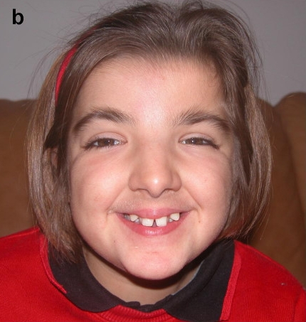 Rubinstein-Taybi Syndrome Images — DermNet